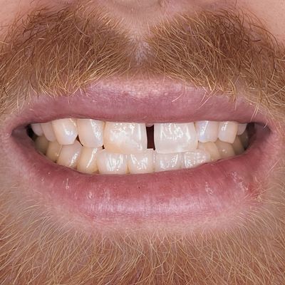 Composite Bonding - Smile 13 before